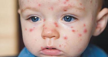 Ентеровирусна инфекција код детета: лечење, симптоми, превенција