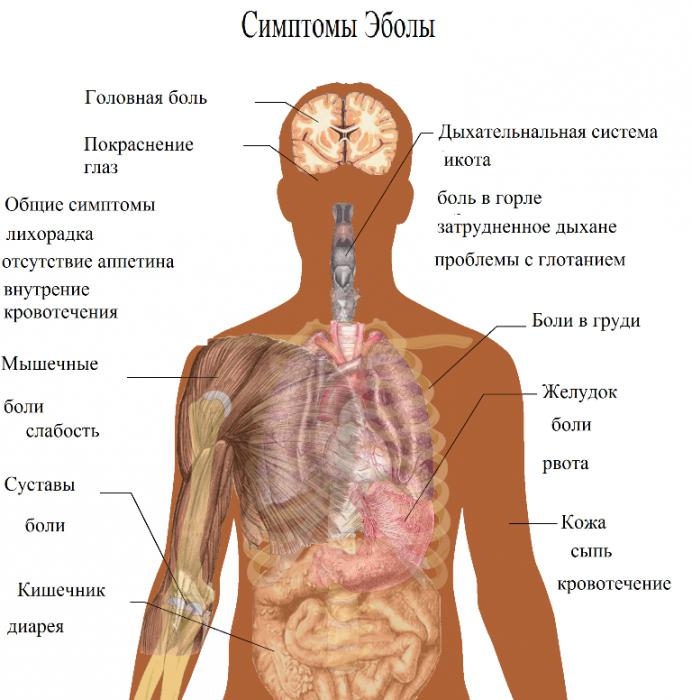 Како се преносе Ебола грозница: симптоми и третман грознице