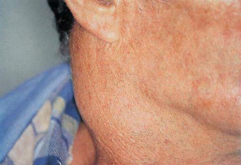 Како се третира лимфни чвор на врату?