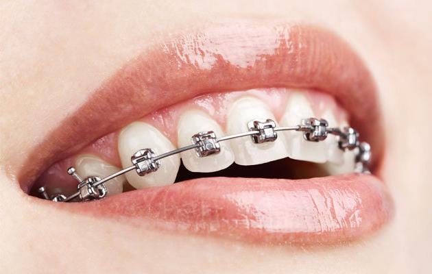 Како поставити кочнице у модерну стоматологију